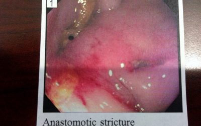 2013-01-24 16.41.38 Colon Stricture