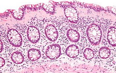 Collagenous colitis Collagenous colitis